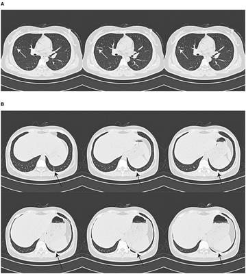Case report: A rare case of meningoencephalitis caused by Mycobacterium gordonae